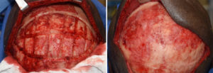Occipital Skull Reduction technique Dr Barry Eppley Indianapolis