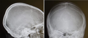 Occipital Skull Reduction x-rays Dr Barry Eppley Indianapolis