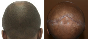 Occipital Skull reduction result4 back view Dr Barry Eppley Indianapolis