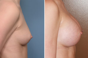 Perfect Breast Augmentation result side view Dr Barry Eppley Indianapolis