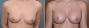 Perfect Breast Augmentation results front view Dr Barry Eppley Indianapolis