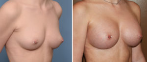 Perfect Breast Augmentation results oblique view Dr Barry Eppley Indianapolis