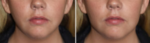 Simulated Vertical Jaw Angle Implant effect Dr Barry Eppley Indianapolis