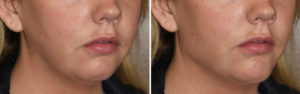 Simulated Vertical Jaw Angle Implant effects oblique view Dr Barry Eppley Indianapolis