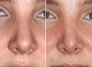 Slimming Nose Rhinoplasty result front view Dr Barry Eppley Indianapolis