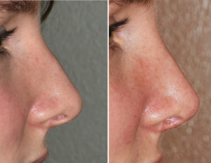 Small Dorsal Hump Rhinoplasty result side view Dr Barry Eppley Indianapolis