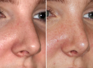 Small Dorsal Humpo Rhinoplasty result oblique view Dr Barry Eppley Indianapolis