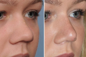 Wide Nose Rhinoplasty result oblique view Dr Barry Eppley Indianapolis