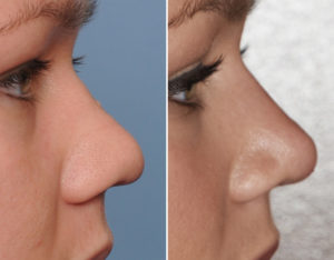 Wide Nose Rhinoplasty result side view