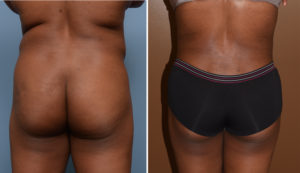 abdominal-back-liposuction