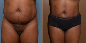 abdominal-flank-liposuction-result-front-view-dr-barry-eppley-indianapolis