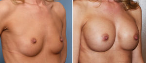 breast-augmentation-and-cleavage-results-oblique-view-dr-barry-eppley-indianapolis