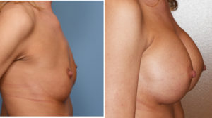 breast-augmentation-and-cleavage-results-side-view-dr-barry-eppley-indianapolis