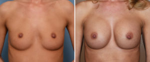 breast-augmentation-with-cleavage-results-front-view-dr-barry-eppley-indianapolis