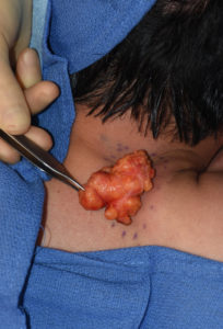 buffalo-hump-lipoma-removal-dr-barry-eppley-indianapolis