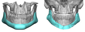 custom-jawline-implant-3d-ct-scan-result-front-view-dr-barry-eppley-indianapolis