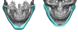 custom-jawline-implant-3d-ct-scan-result-top-view-dr-barry-eppley-indianapolis