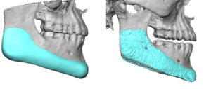 custom-jawline-implant-3d-ct-scans-side-view-dr-barry-eppley-indianapolis