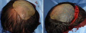 custom-occipital-implant-fo-asymmetry-dr-barry-eppley-indianapolis