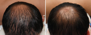 custom-occipital-implant-intraop-result-back-view-dr-barry-eppley-indianapolis