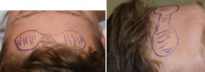 forehead-horn-reduction-dr-barry-eppley-indianapolis