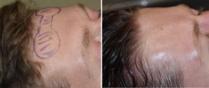 forehead-horn-reduction-surgery-intraop-results-side-view-dr-barry-eppley-indianapolis