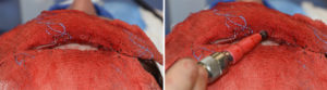 forehead-reduction-surgery-technique-burr-guarding-dr-barry-eppley-indianapolis