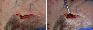 hairline-approach-to-temporal-implants-intraop-1-dr-barry-eppley-indianapolis