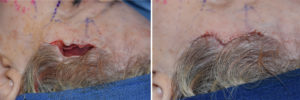 hairline-approach-to-temporal-implants-intraop-3-dr-barry-eppley-indianapolis