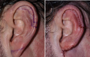 Macrotia Reduction intraop left ear Dr Barry Eppley Indianapolis