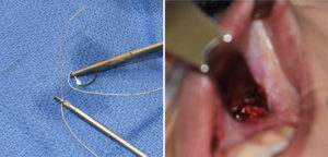 nasal-base-fixation-technique-dr-barry-eppley-indianapolis