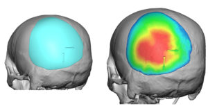 occipital-implant-design-for-plagiocephaly-dr-barry-eppley-indianapolis