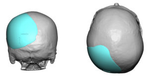 occipital-implant-for-plagiocephaly-design-dr-barry-eppley-indianapolis