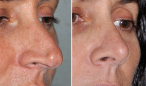 Pinocchio Nose Rhinoplasty result oblique view Dr Barry Eppley Indianapolis