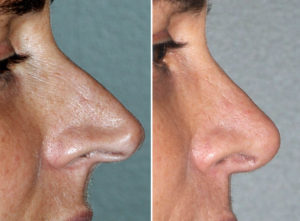Pinocchio Nose Rhinoplasty result side view Dr Barry Eppley Indianapolis