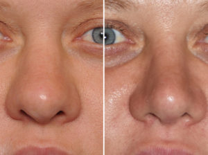 thick-nose-revision-rhinoplasty-result-front-view-dr-barry-eppley-indianapolis