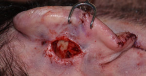 tissue-bank-cartilage-in-otoplasty-reversal-dr-barry-eppley-indianapolis