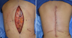 vertical-back-lift-intraop-result-dr-barry-eppley-indianapolis