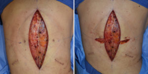 vertical-back-lift-intraop-technique-2