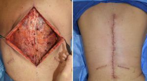 vertical-back-lift-intraop-technique