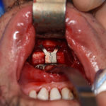 vertical-lengthening-genioplasty-with-interpositional-bone-graft-dr-barry-eppley-indianapolis