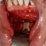 vertical-lengthening-genipplasty-with-interpositional-bone-graft-oblique-view-dr-barry-eppley-indianapolis