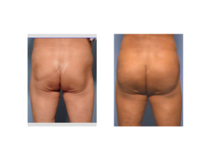 asian-buttock-implants-result-back-view-dr-barry-eppley-indianapolis