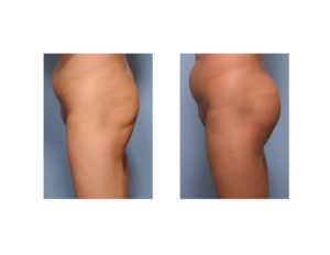 asian-buttock-implants-result-side-view-dr-barry-eppley-indianapolis