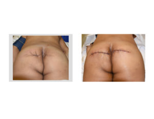 buttock-reconstruction-with-dermal-fat-grafts-back-view-dr-barry-eppley-indianapolis