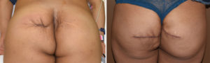 buttock-reconstruction-with-dermal-fat-grafts-result-bvack-view-dr-barry-eppley-indianapolis