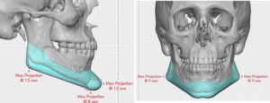 custm-jawline-implant-dimensions-dr-barry-eppley-indianapolis