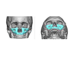 custom-midface-implant-design-dr-barry-eppley-indianapolis