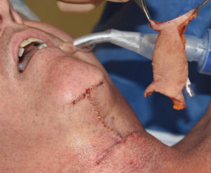 direct-necklift-wattle-excision-dr-barry-eppley-indianapolis