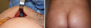 intramuscular-buttock-implants-incision-dr-barry-eppley-indianapolis